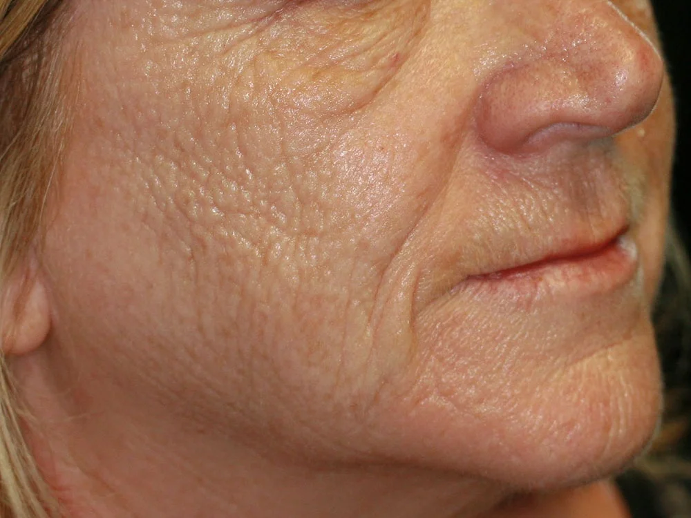 Collagen Induction Therapy - Before