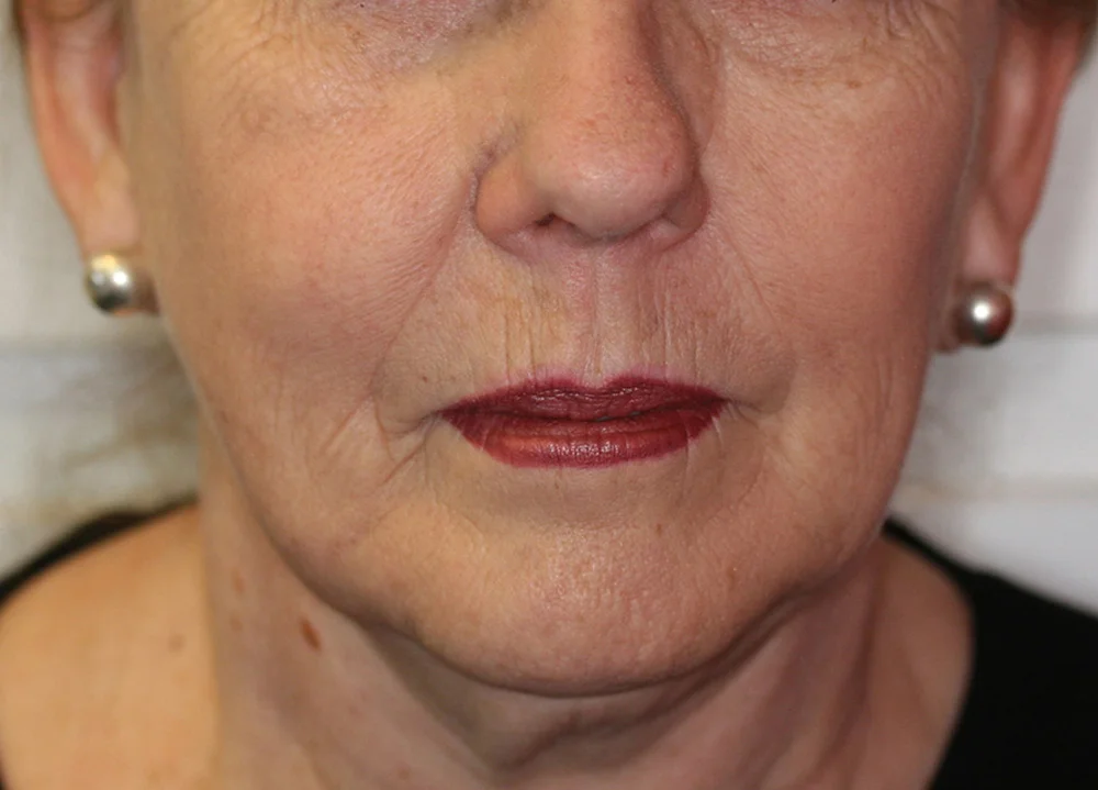 Face Thread Lifting - Before