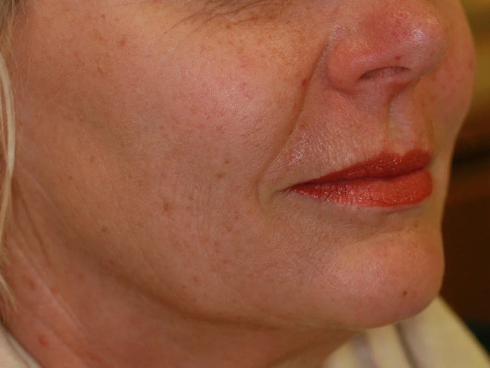 Face Thread Lifting - After