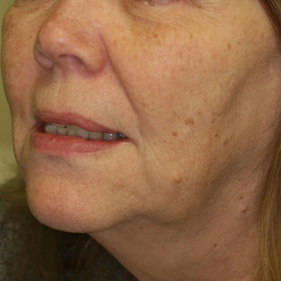 Face Thread Lifting - Before