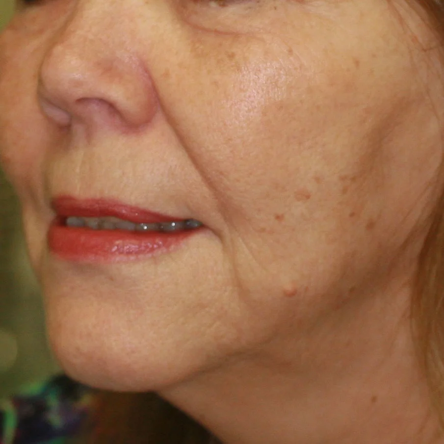 Face Thread Lifting - After