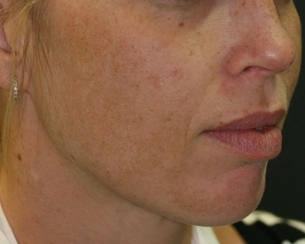 Fraxel - Before