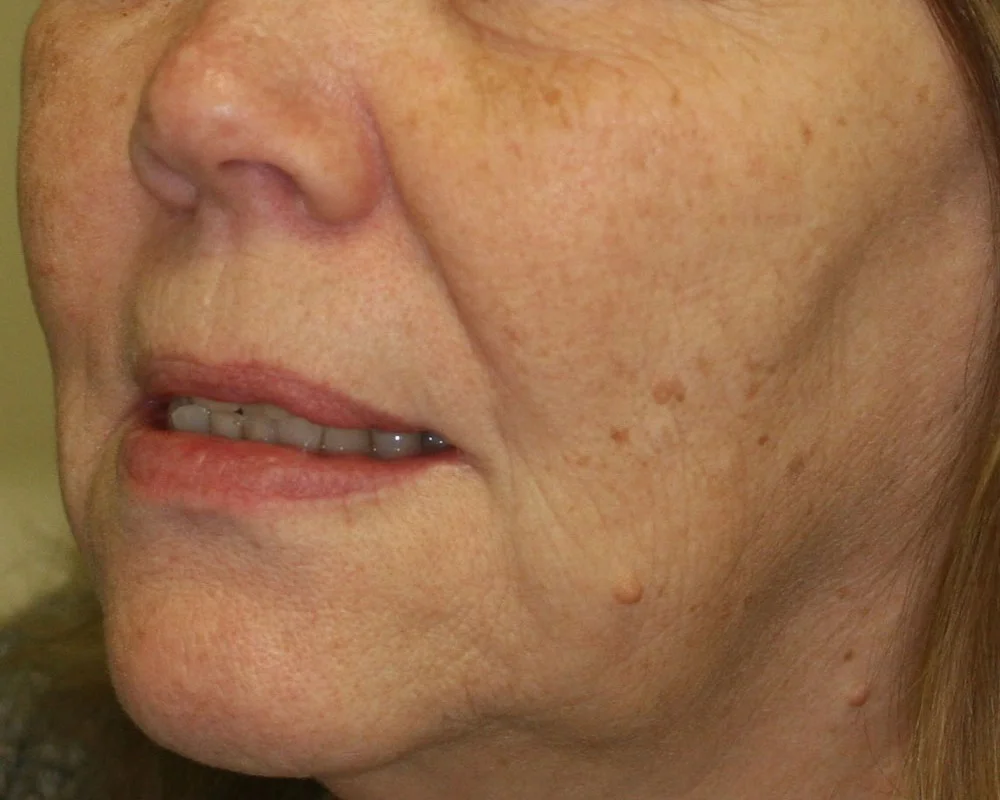 Keyhole Facelifting - Before