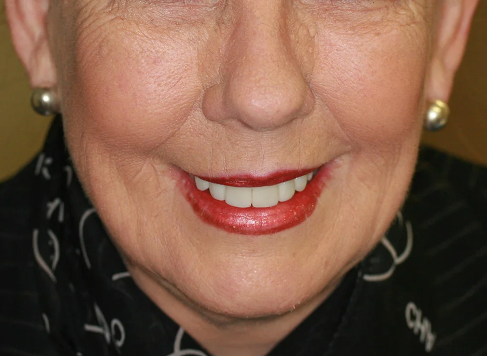 Keyhole Facelifting - After