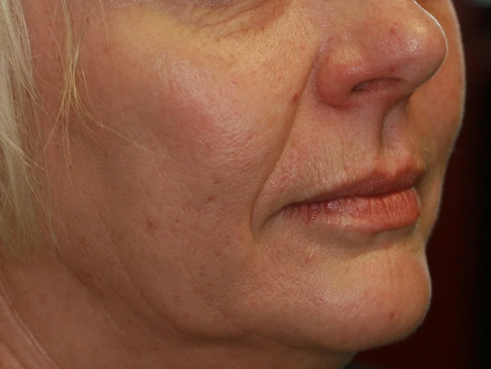 Keyhole Facelifting - Before