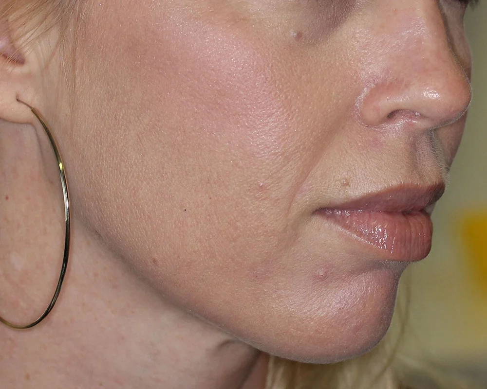 Laser Therapies - After