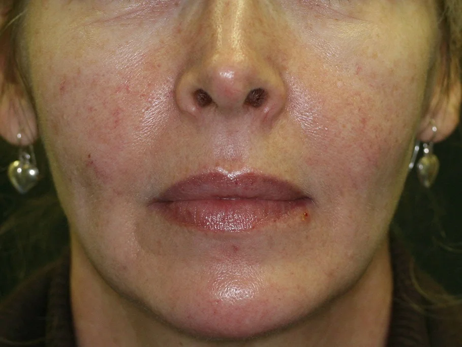Laser Therapies - Before