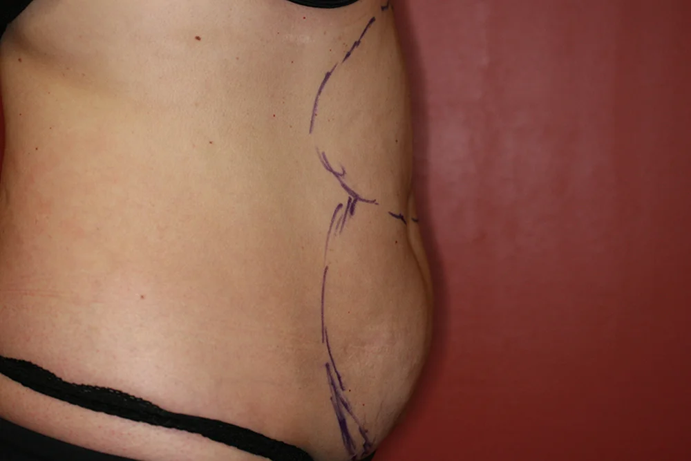 Liposculpture - Before