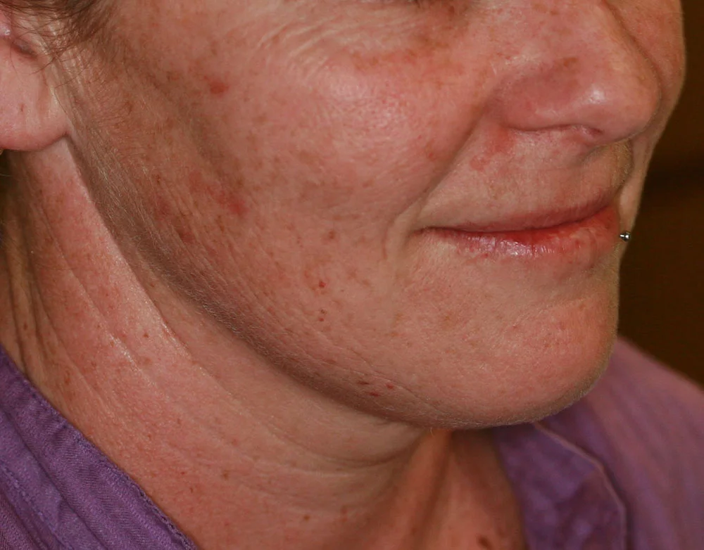 Platelet Rich Plasma - Before