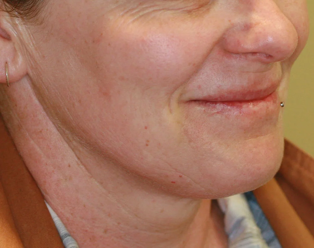 Platelet Rich Plasma - After