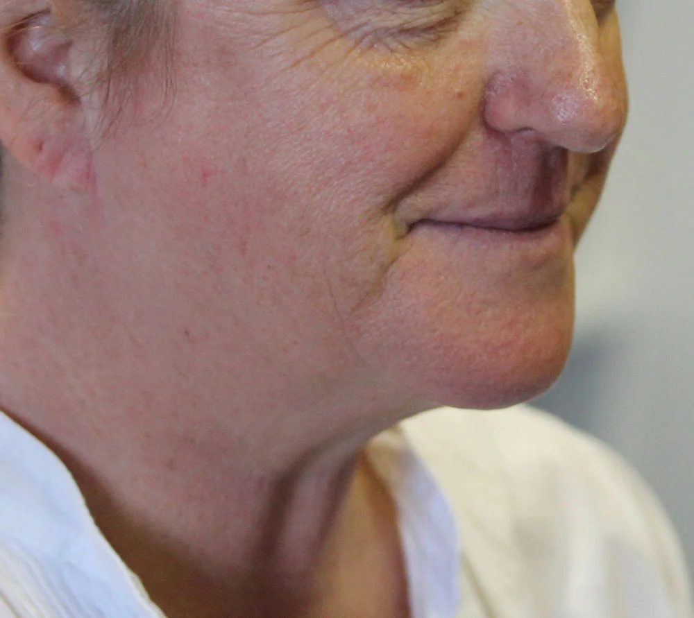 Collagen Induction Therapy (CIT) - Before