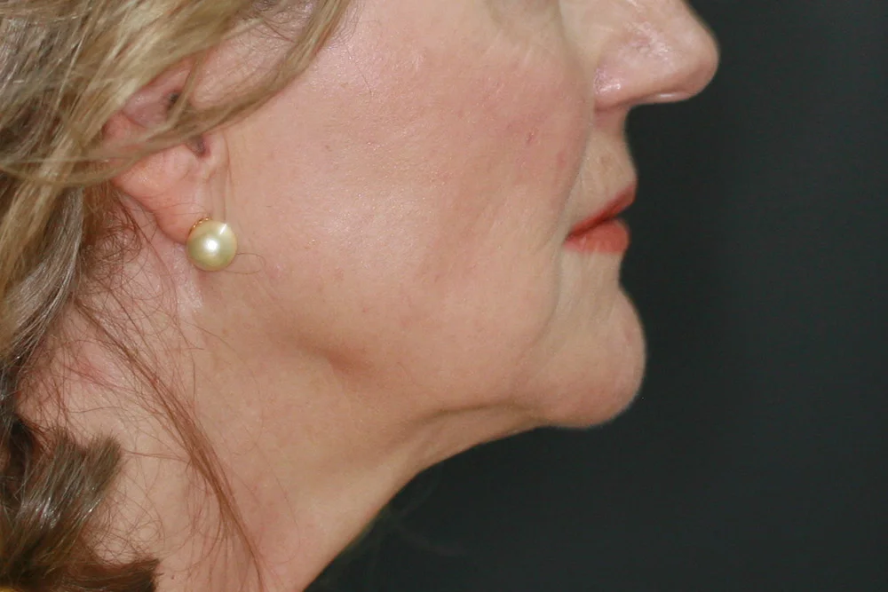 Liposculpture - After