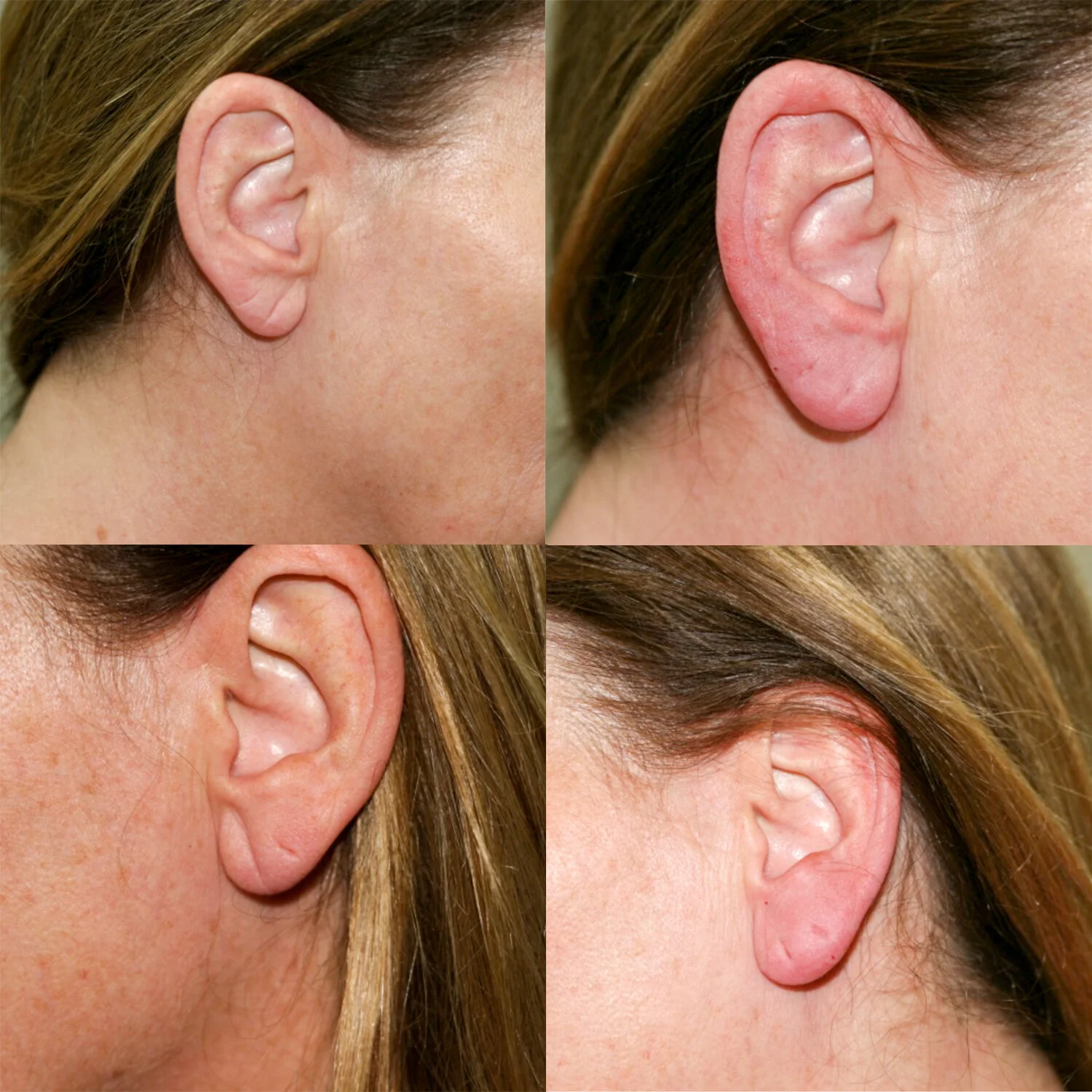 Saggy Earlobes? We Hear You