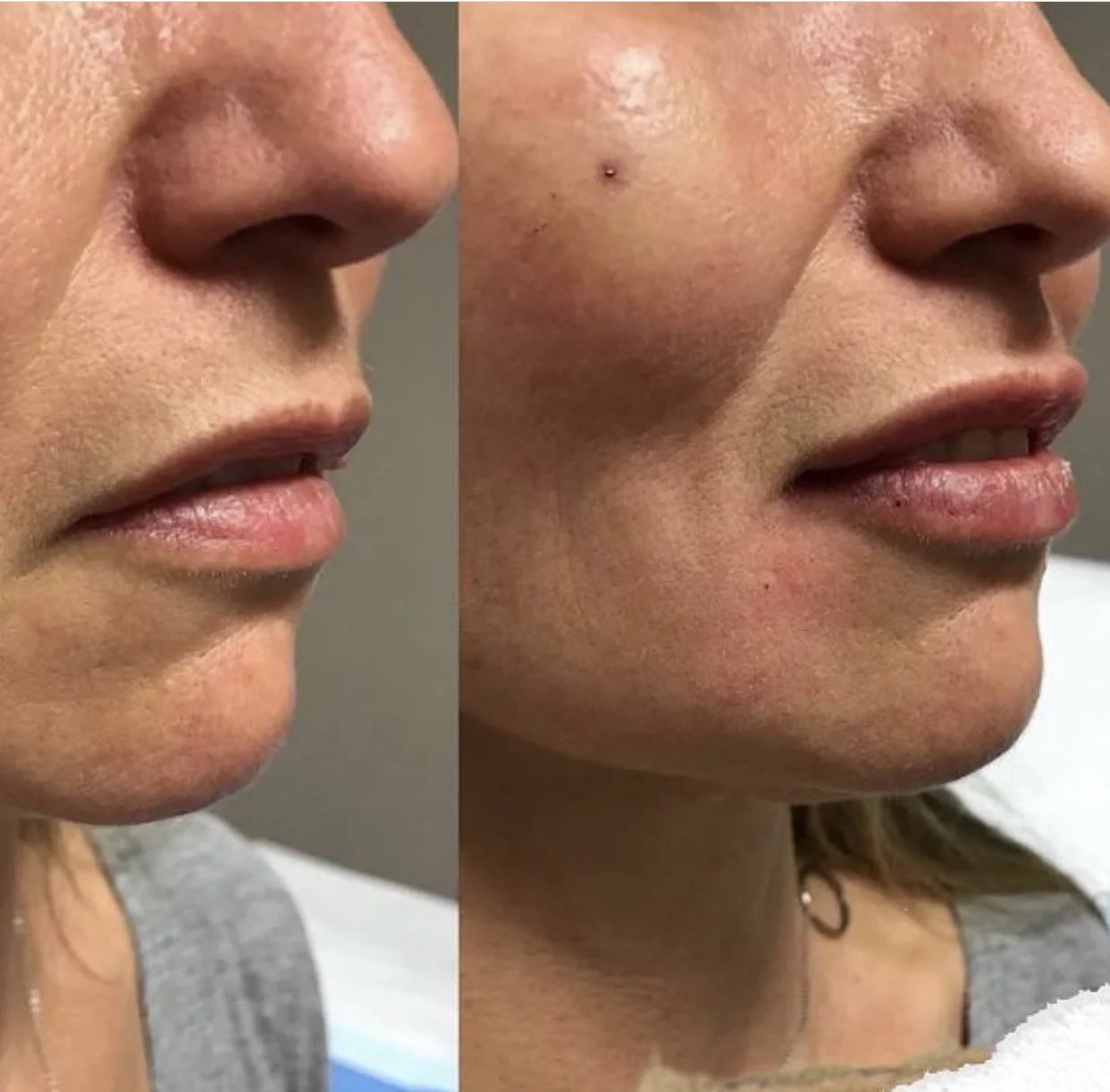 Lip Enhancement