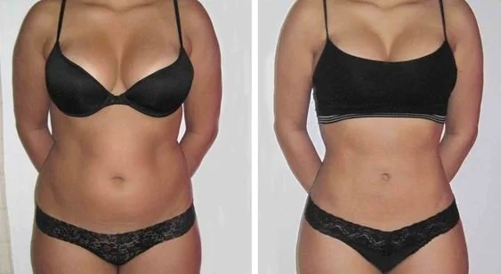 Liposculpture