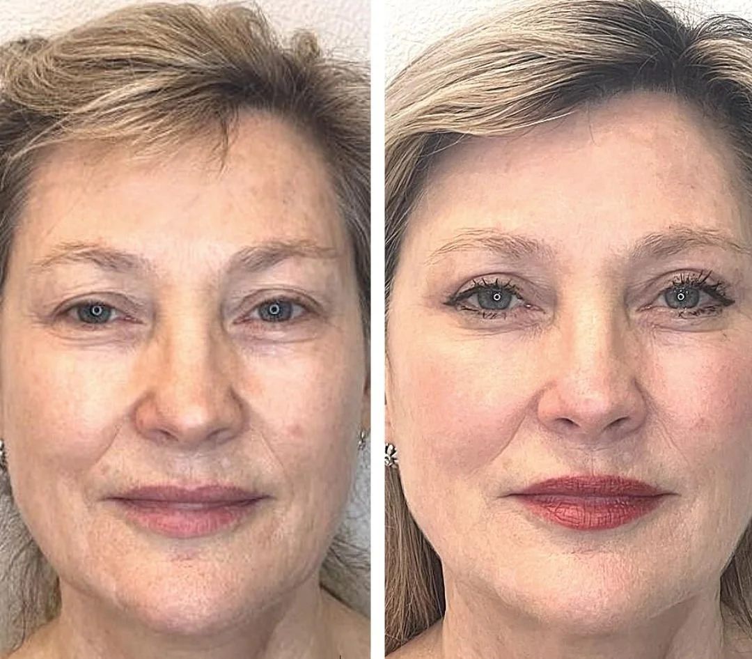 Eyelid Surgery - Blepharoplasty (Skin Only or Tissue-sparing)