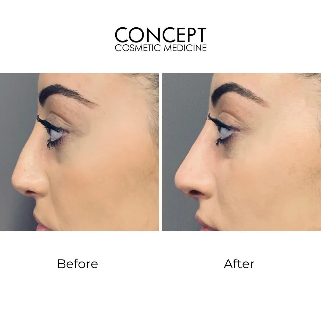 Just a few years ago, if you wanted a new nose&mdash;smaller, straighter, smoother&mdash;you could either a.) have a rhinoplasty or b.) that's it. You had no other options. 
We now have a treatment called non-surgical rhinoplasty. It is a procedure d