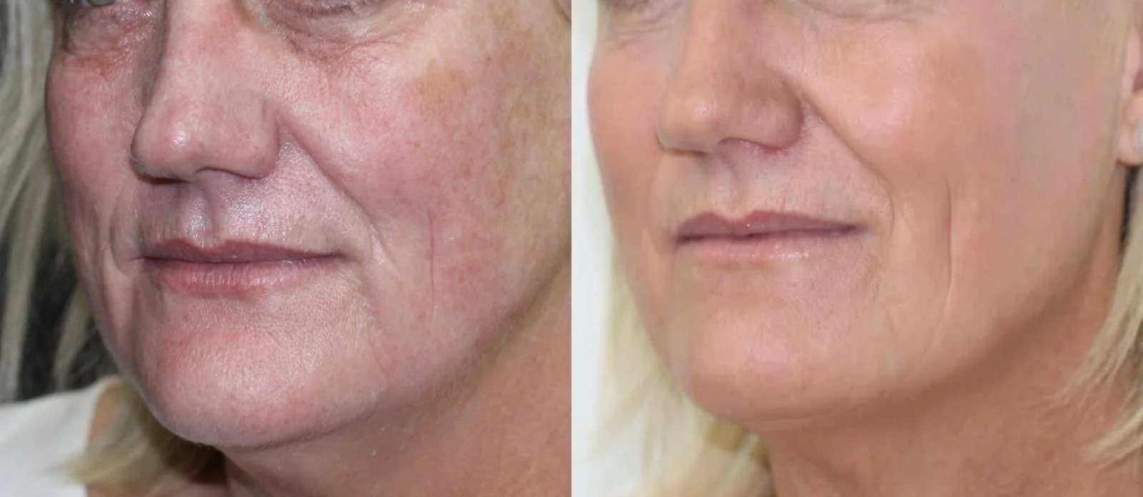 Fraxel Repair™ (Fractional CO2)