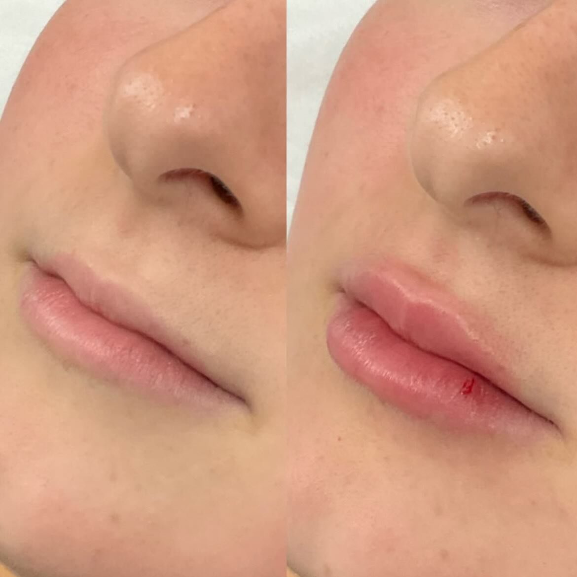 Tis the season to pucker up! 💋 Let Nurse Abbey help you get your lips mistletoe-ready with rehydration and rejuvenation treatments for natural and soft results. 

#sydneylips #sydneylipenhancement #lipfillerbeforeandafter #rejuran #rejuranlift #salm