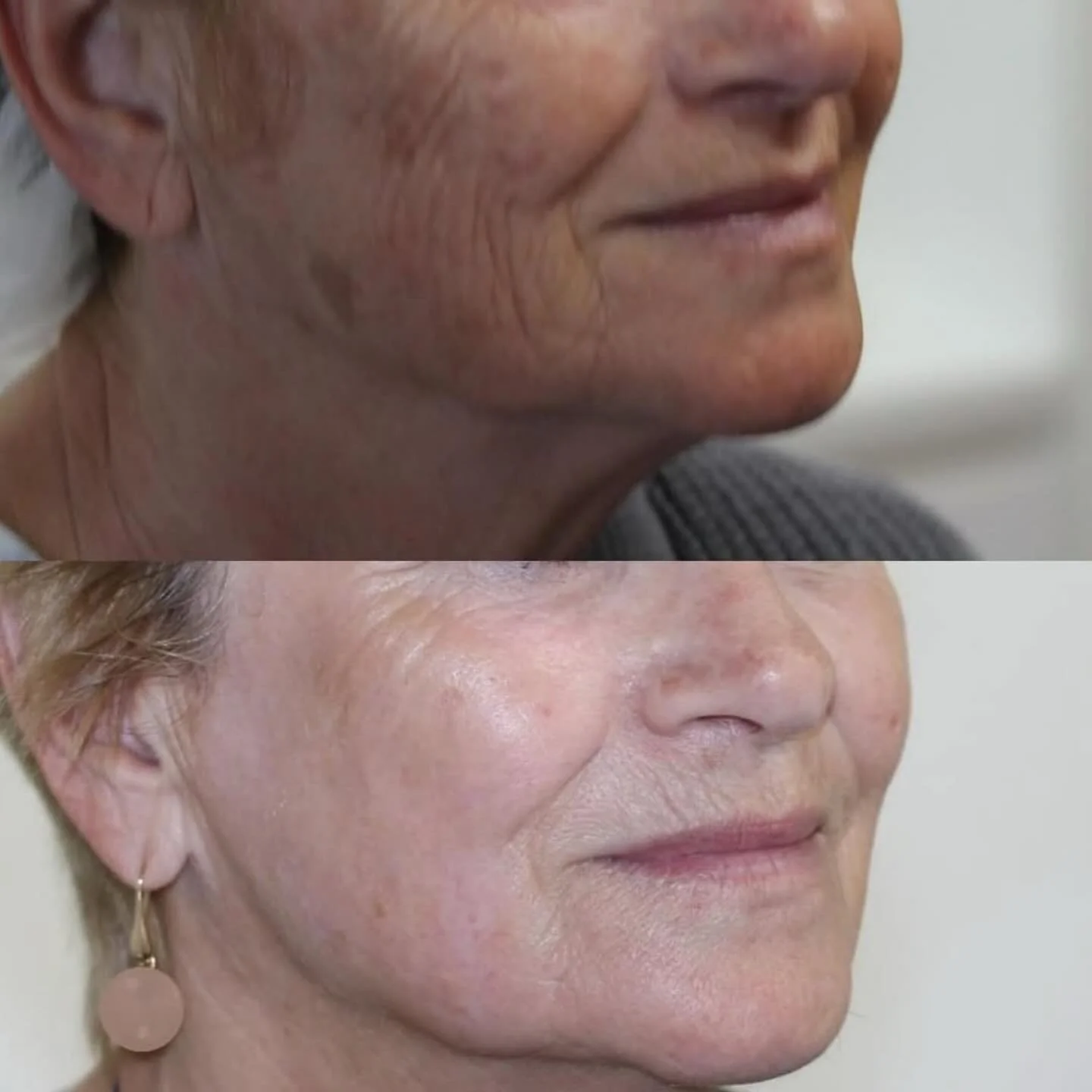 Dr Stefan&rsquo;s patient incredible results with Collagen Induction Therapy! 

Collagen Induction Therapy (CIT)! This cutting-edge aesthetic treatment addresses fine lines, sun damage, crepey skin, and acne scars and enhances your skin&rsquo;s overa