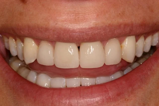 after veneers.jpeg
