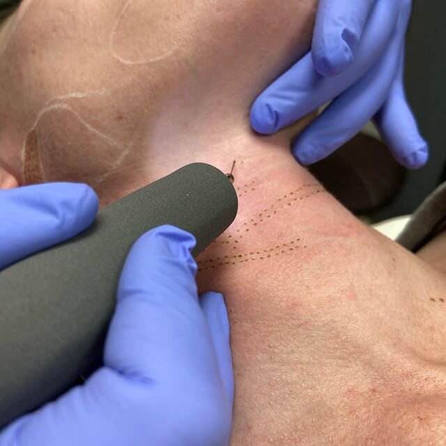 Just playing around with our new subnovii! Our client did her tech neck, chin laxity, undereyes, and Jawline! 5-7 days from now she will be picture ready! Call or text 8123202284 to book for our introductory rate! #medspa #cartessaaesthetics #plasma 