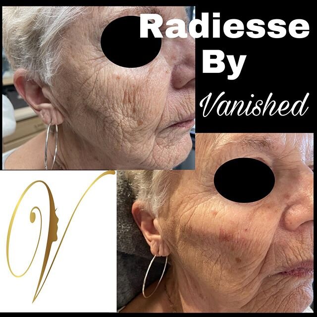 Radiesse Cheek Augmentation can be beneficial at any age. Check out the lift for this lovely lady. #medspa #radiesse #nonsurgicalfacelift #cheekfillers #bloomingtonindiana #bloomington #bloomingtonsalon #bloomingtonspa #vanishedfamily #modernsalon