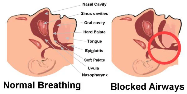 sleep-apnea-diagram-SS.jpg