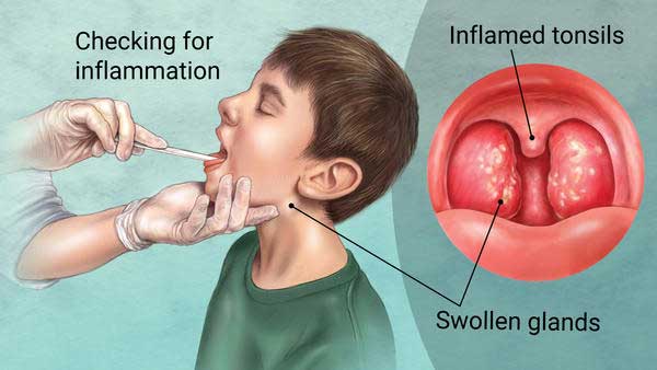 The Difference Between Strep Throat and Tonsillitis