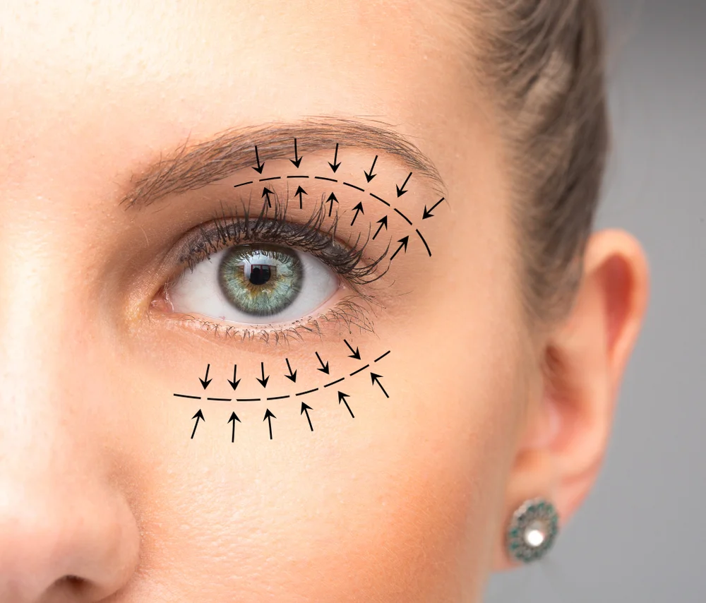 Effect of Blepharoplasty on Women