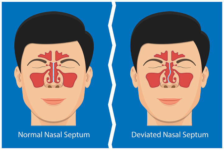 A Deviated Septum Can Affect Your Daily Life