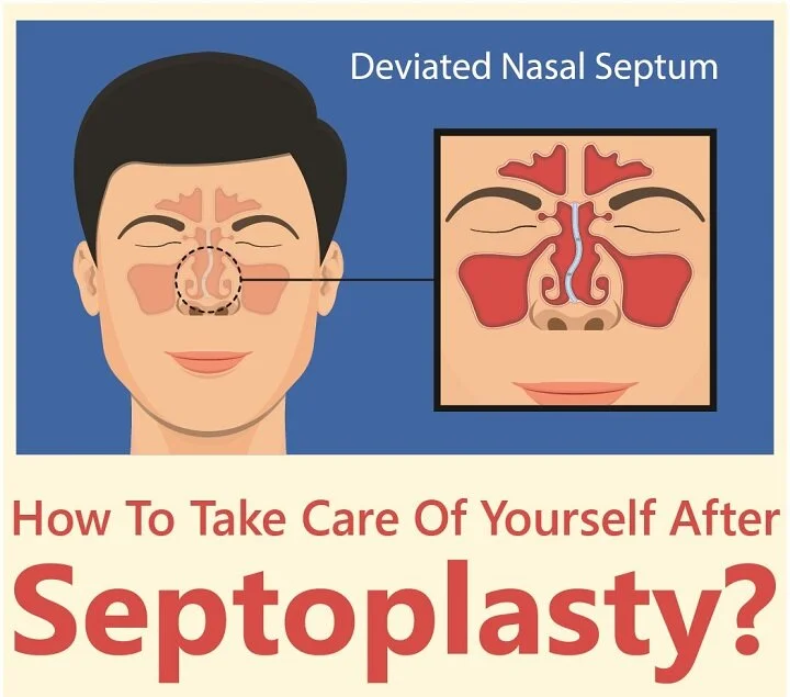 How To Care Of Yourself After Septoplasty?