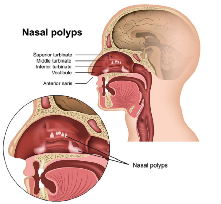 Nasal Polyps: Symptoms, Causes &amp; Treatment