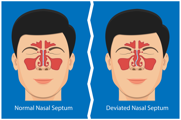 What Are Some Common Symptoms &amp; Treatments for Deviated Septum?