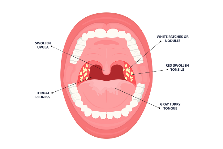 Do You Need to Worry About Tonsil Stones?