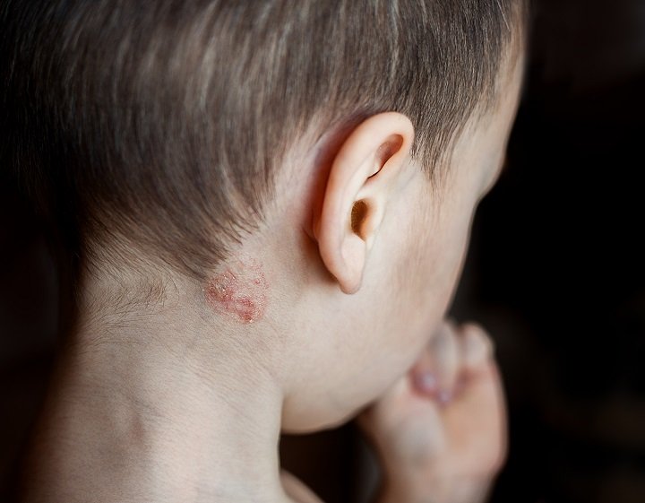 Understanding the Lichen Planus Syndrome Accurately