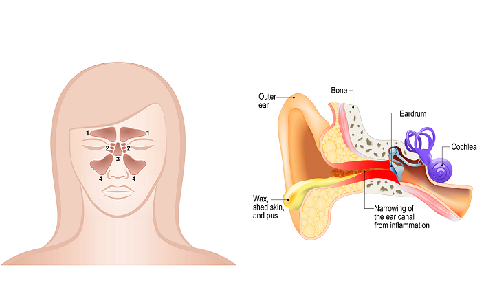 sinus canal infection