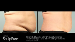 SculpSureBA_SidebySide_Female11.jpg