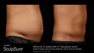 SculpSureBA_SidebySide_Male1.3.jpg