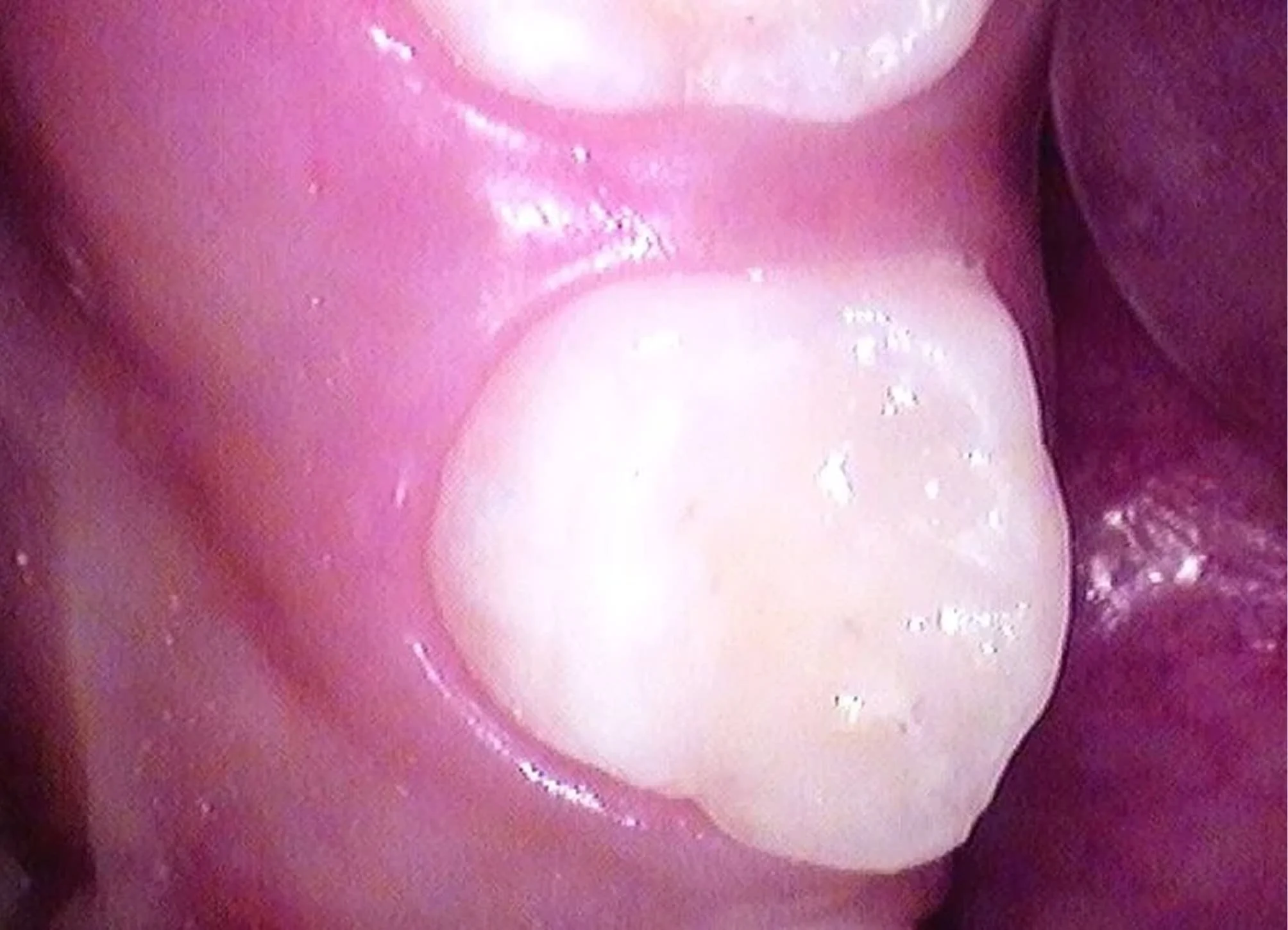 Tooth Treated With SDF