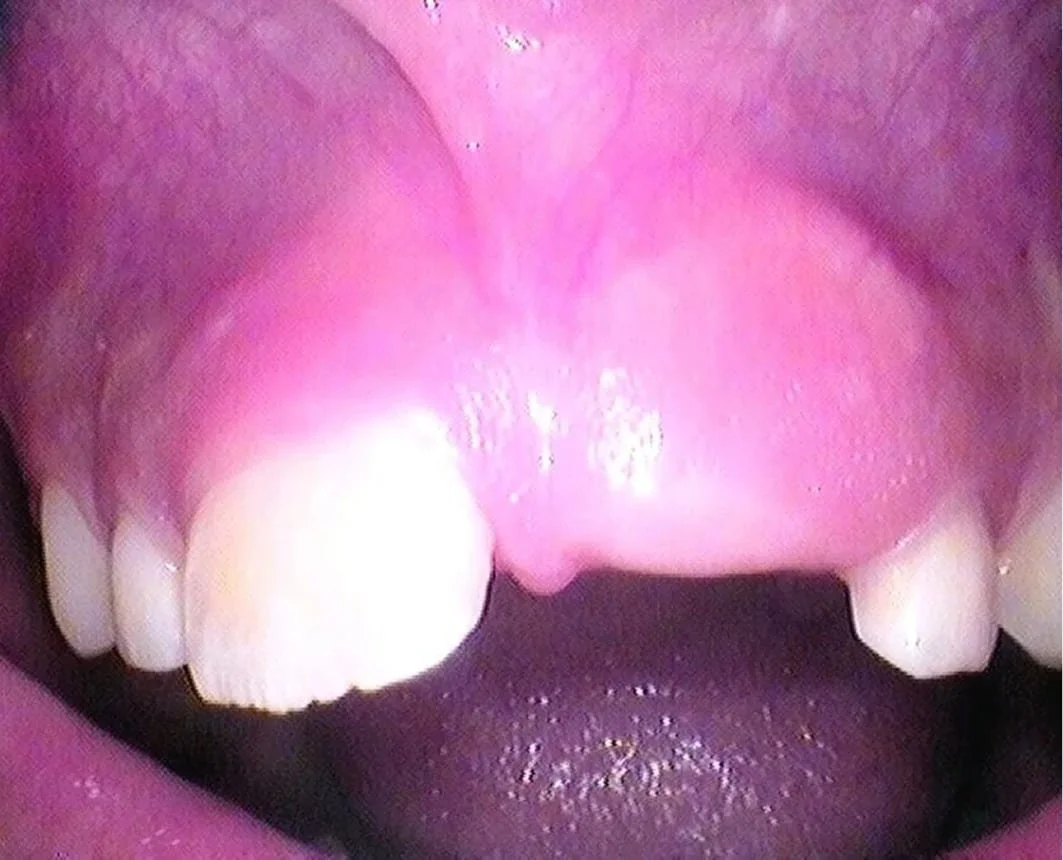 Before (Tooth Trapped Under  Gum Tissue)