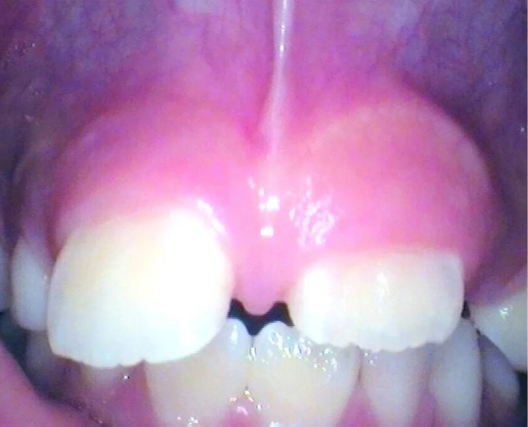 After (Tooth Erupting After Surgery)