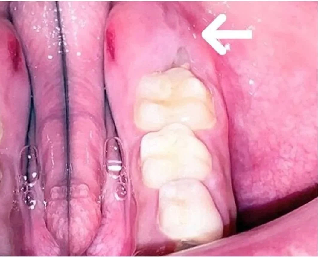 Before (Tooth Trapped Under Gum Tissue)