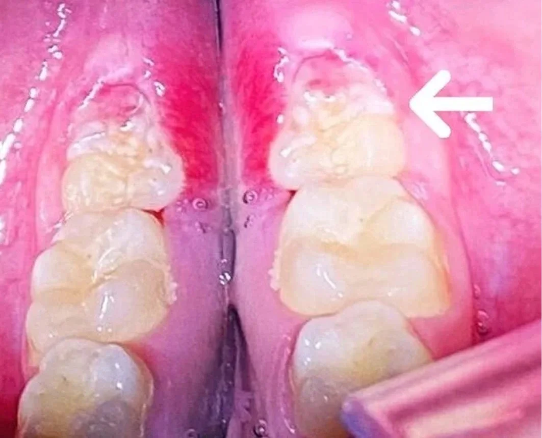 After (Tooth Erupting After Surgery)