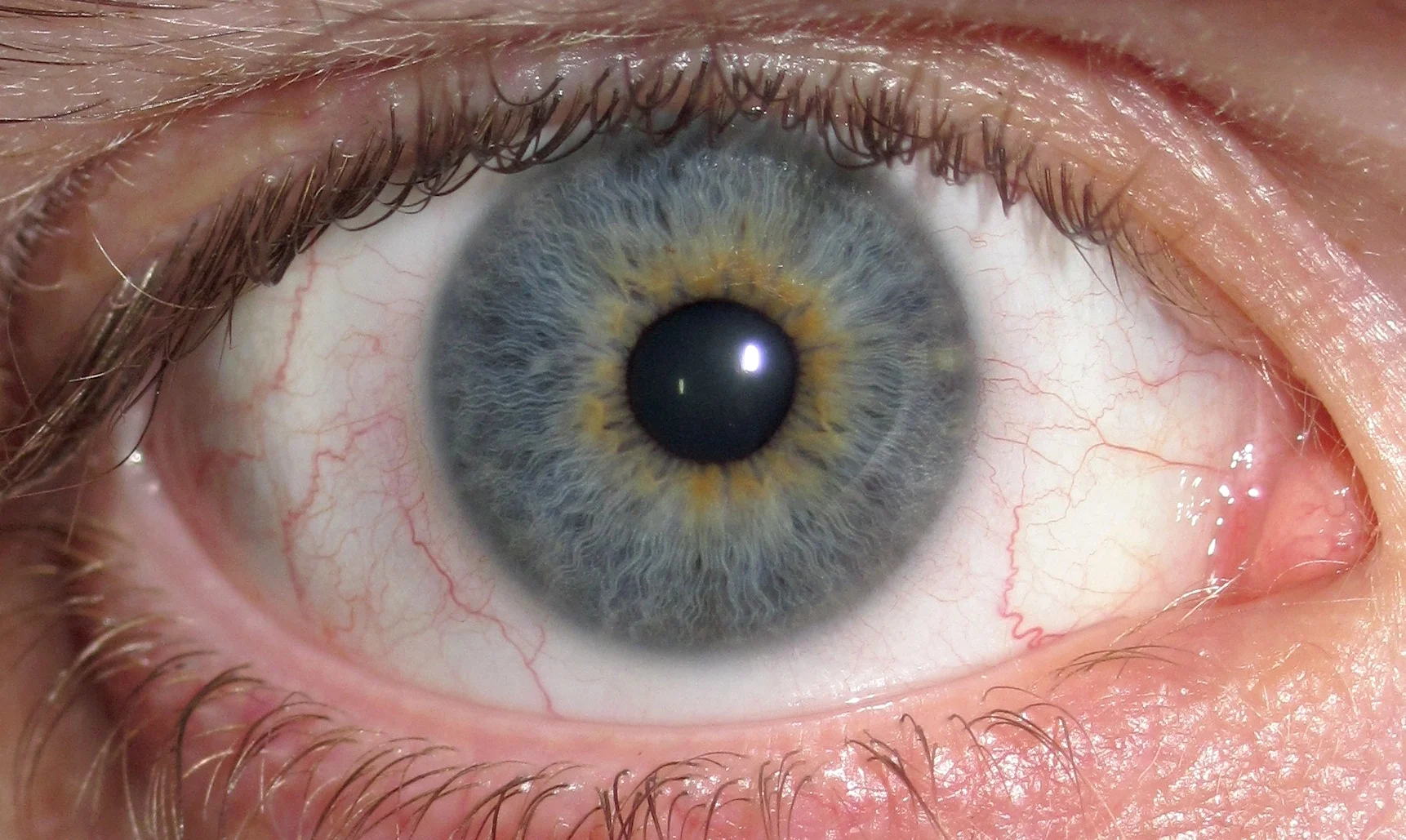 Originally designed to treat this condition, Botox is often a forgotten remedy.