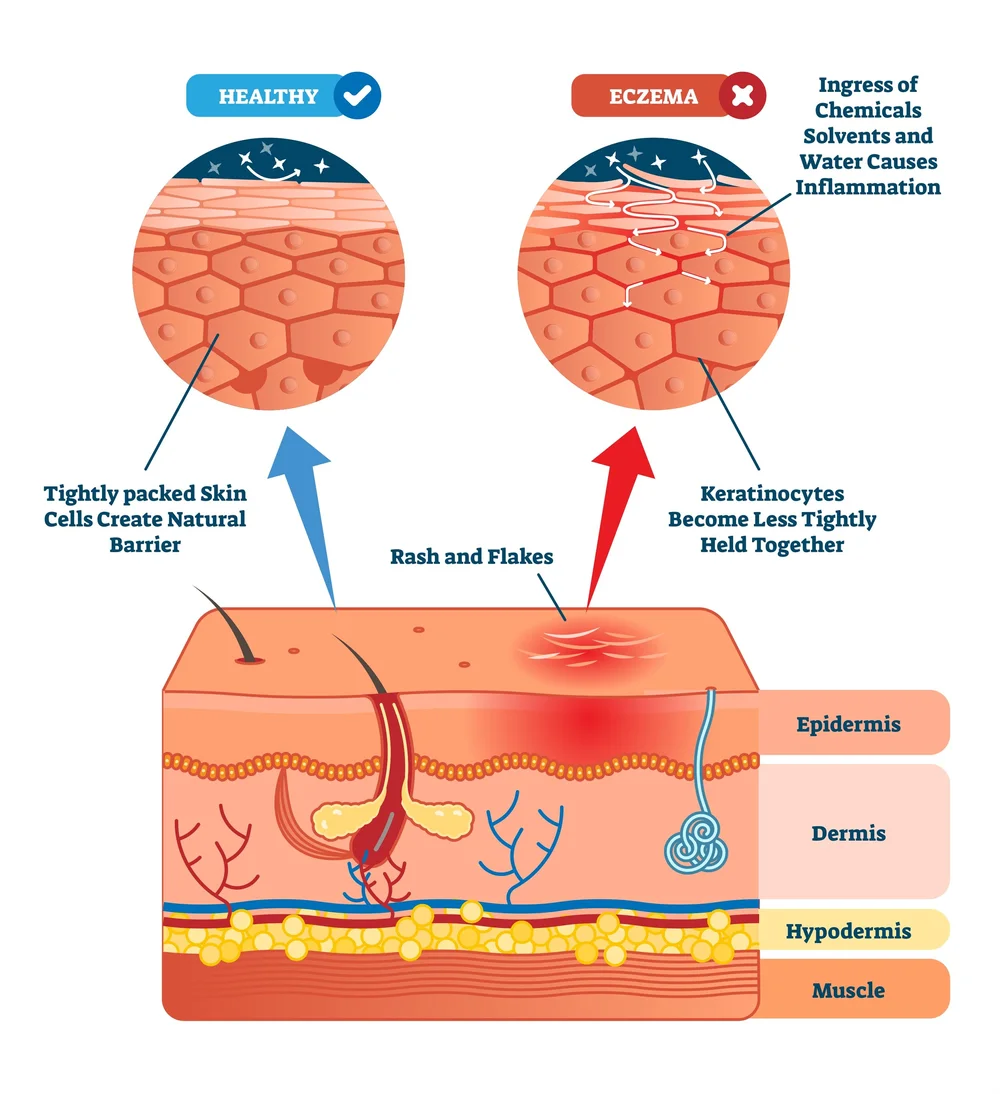 Eczema Skin Health Beauty