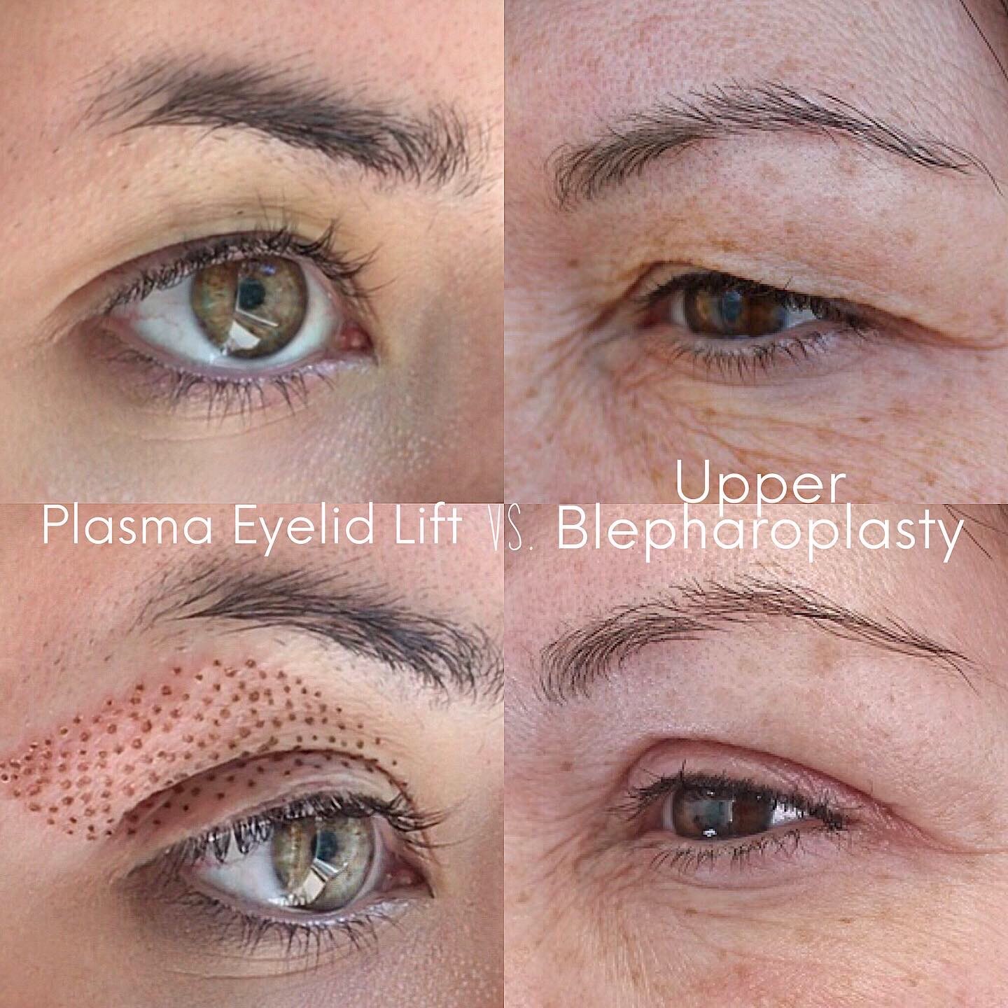 plasma-lift-skin-tightening-proud-brow