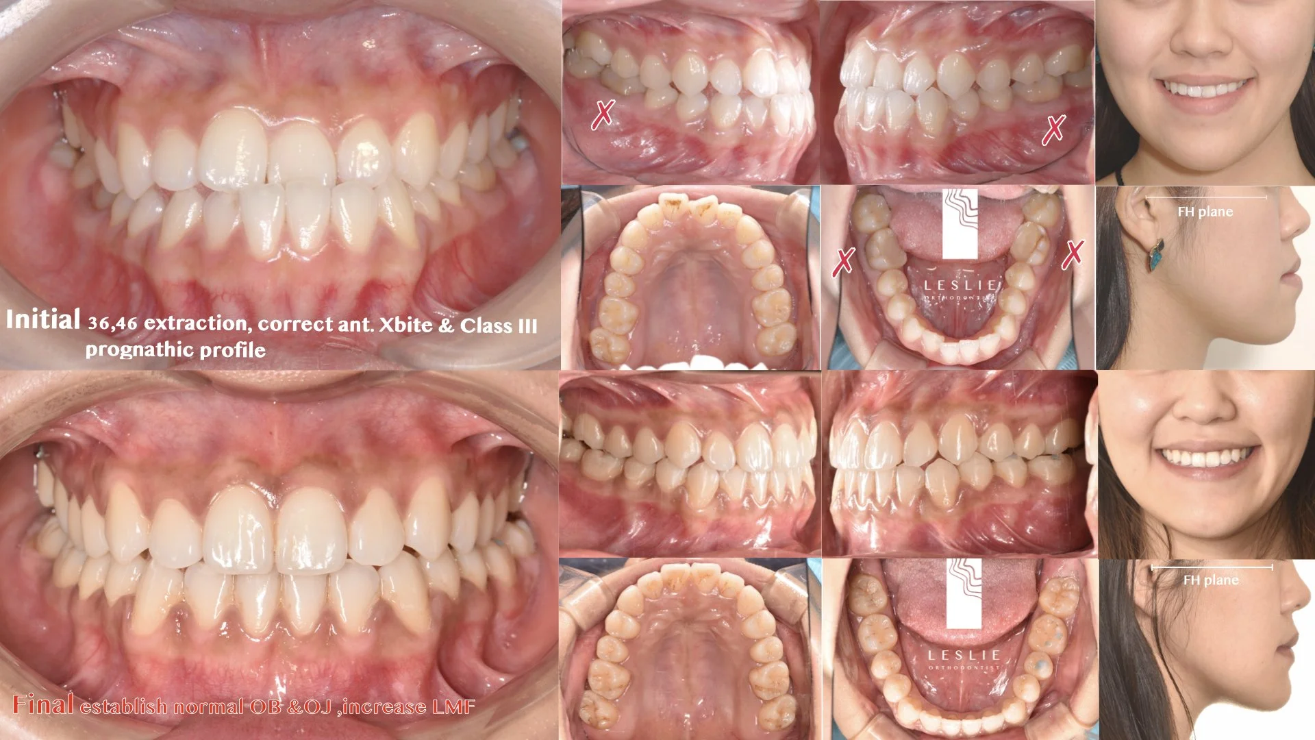 anterior crossbite.002.jpeg