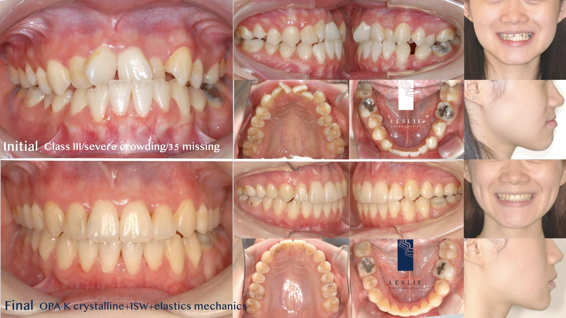 anterior crossbite.003.jpeg