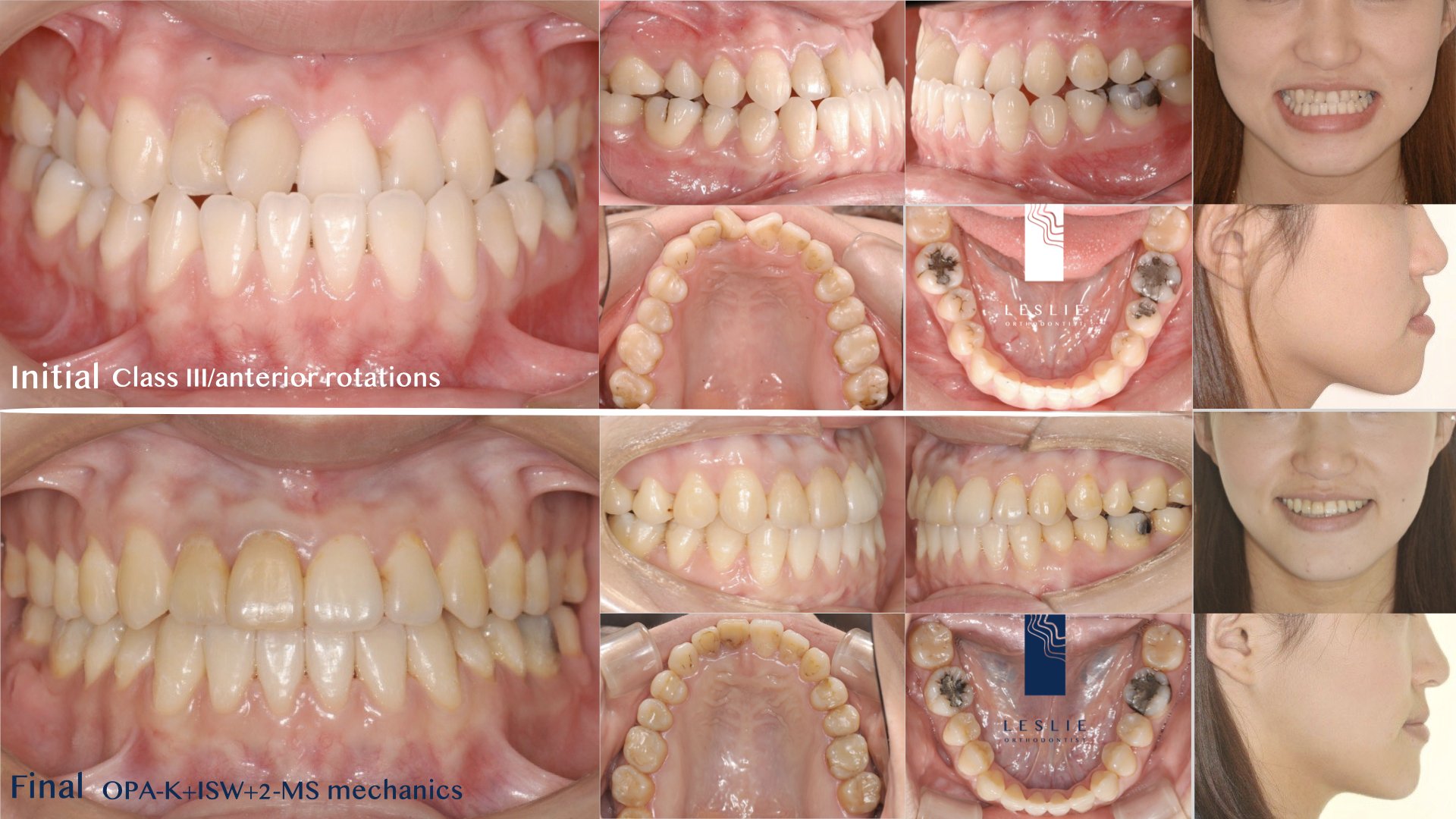 anterior crossbite.004.jpeg